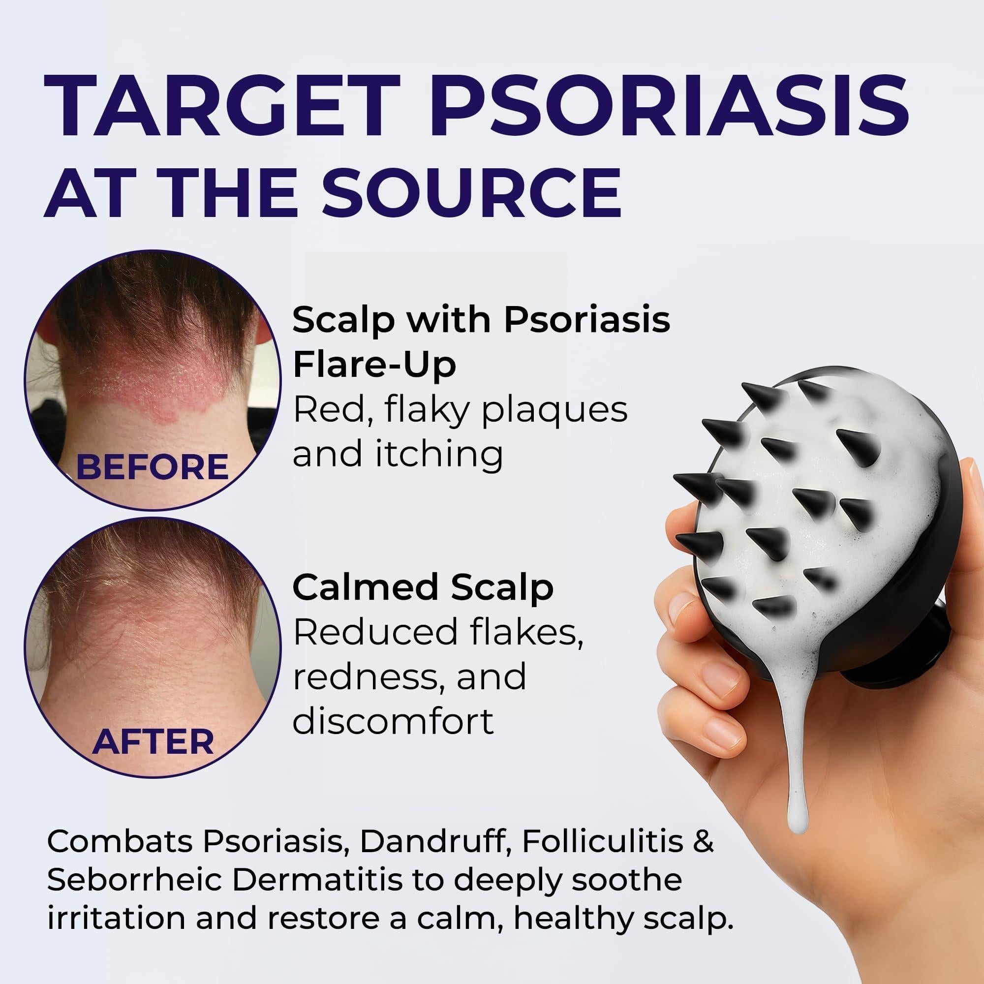 Scalp Psoriasis Shampoo Flakes Anti Dandruff Itchy Scalp Treatment for Seborrheic Dermatitis & Folliculitis Anti Fungal Medicated Solution for Itchy Flaky & Dry Hairs